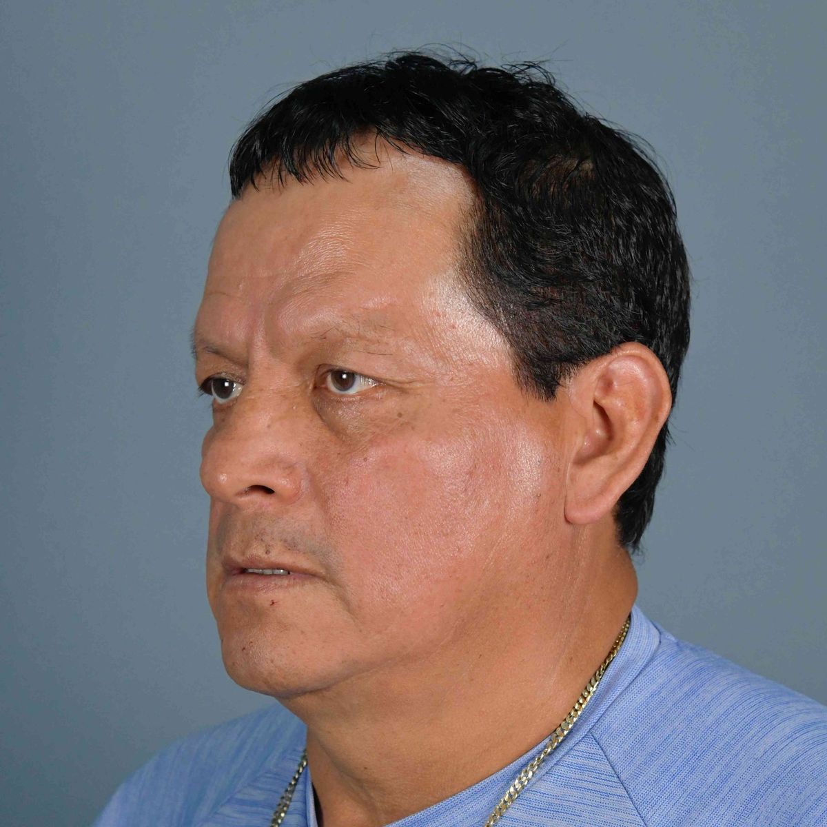 Blefaroplastia — caso real del Dr. Latorre