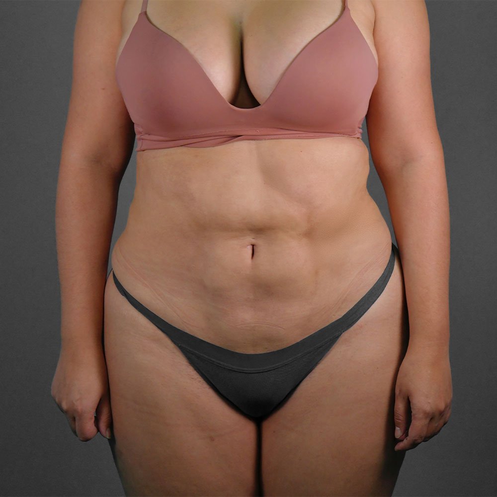 Lipoescultura — caso real del Dr. Latorre