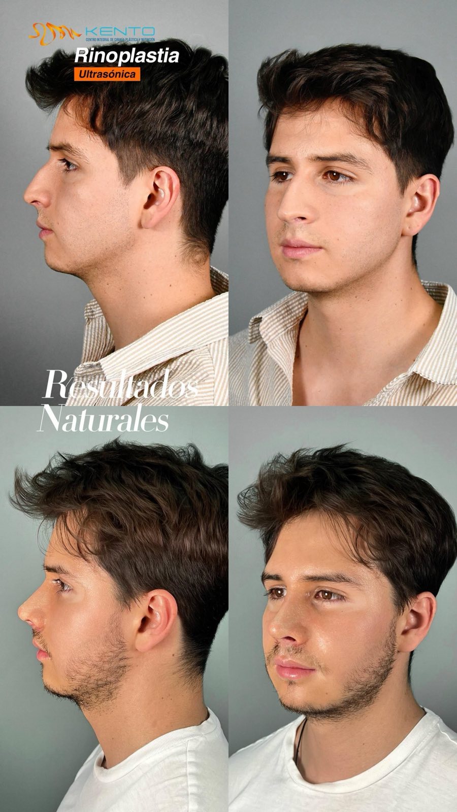 Rinoplastia masculina — resultado caso real